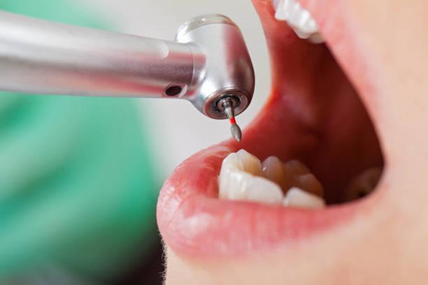 Best Emergency Treatment for Dental Infections or Abscesses in Unionville, NC